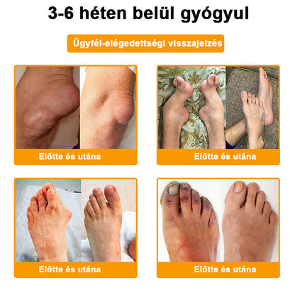 💧🐝ADNOON® Botulinum Toxin & Méhméreg Fájdalomcsillapító Csontgyógyító Krém👨‍⚕️A Magyar Ortopéd Társaság (MOT) Által Jóváhagyva