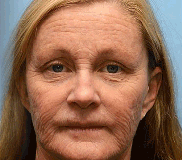 🐝🎁 Már csak 5 doboz maradt! További 50%-os kedvezményt kínálunk! Szerezzétek vissza az alakotokat és egészségeteket. Most veszítsetek, és nem lesz több lehetőség jövő évig.